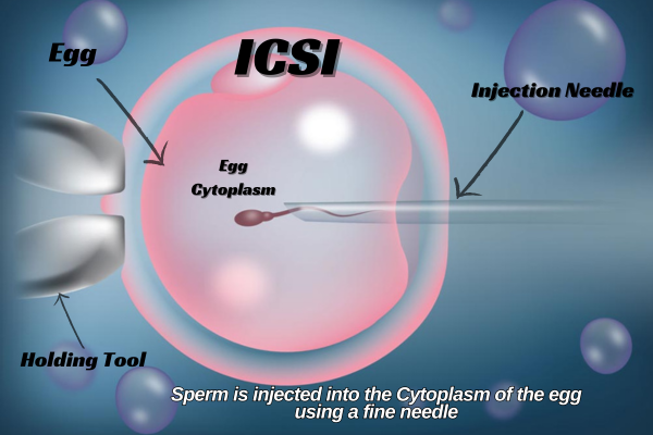 Fertility Solutions for Male Infertility & Fertilisation Challenges
