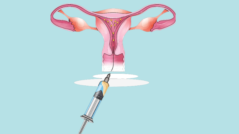 IUI