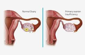 Premature Ovarian Insufficiency (POI)